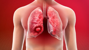 4 dấu hiệu của cơ thể cảnh báo ung thư phổi